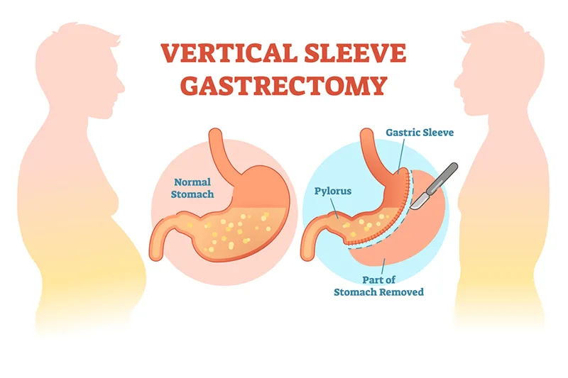 Gastric Sleeve In Iran