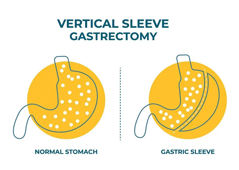 Gastric Sleeve In Iran