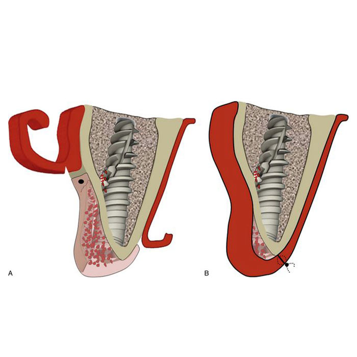 Ridge Modification iran