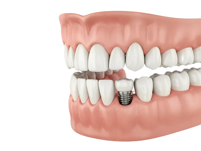 best dental implant dentist iran