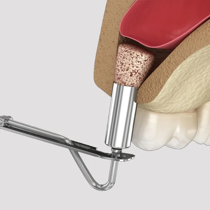 sinus lift implant iran