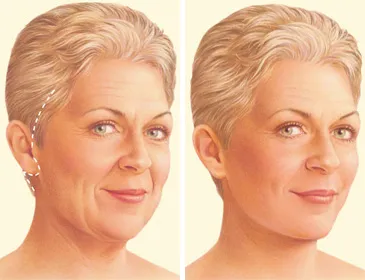 Facelift Surgery in iran