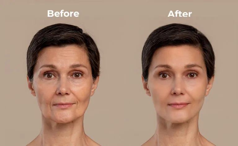 Leading Hub for Facelift Surgery in Iran