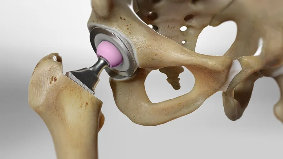 Hip Replacement in Iran