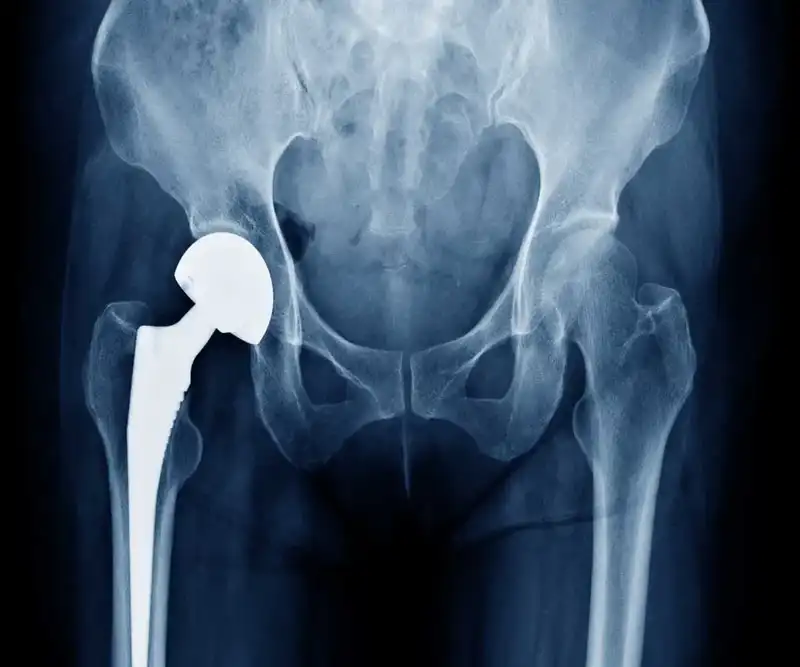 Hip Replacement in Iran