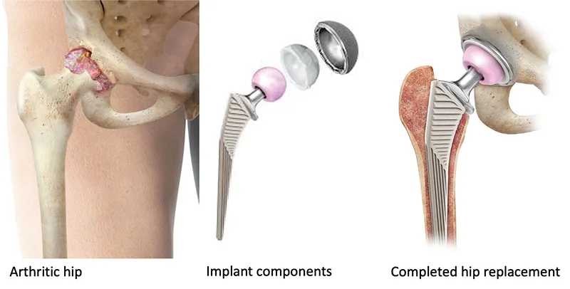 Hip Replacement in Iran