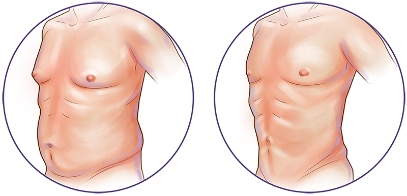 Liposuction in Iran