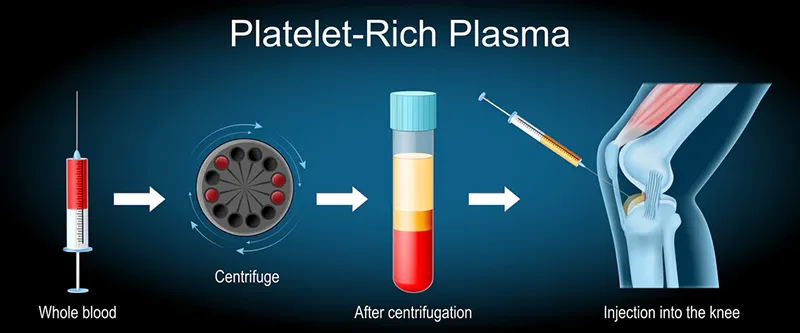PRP (Platelet Rich Plasma) in Iran