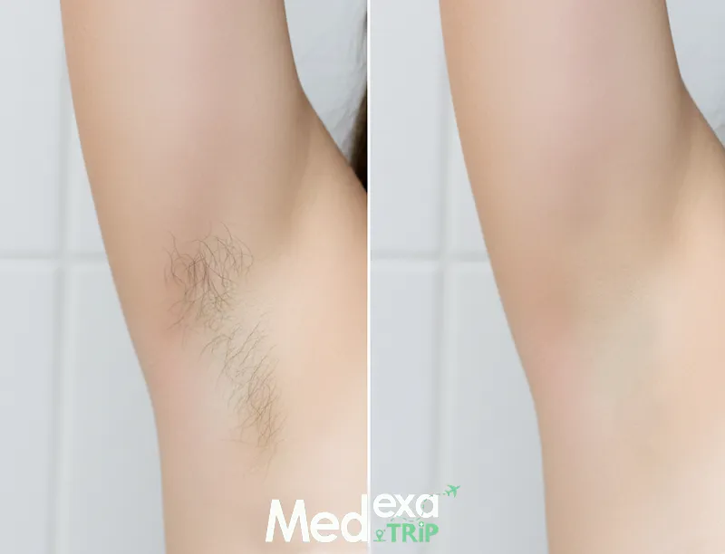 اسعار ليزر الجلد في ايران