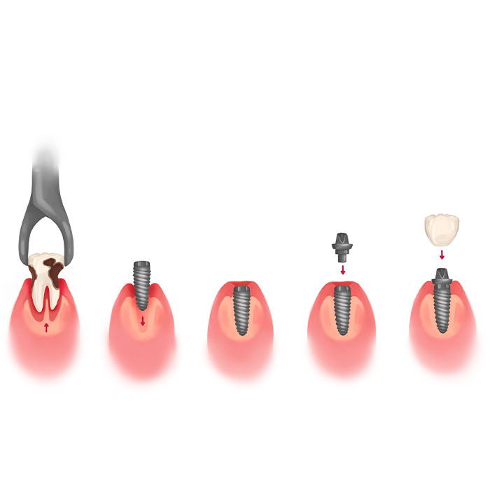 الزرعة الفورية في إيران