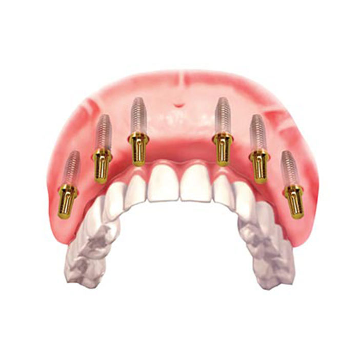 زراعة الفك الكامل في إيران
