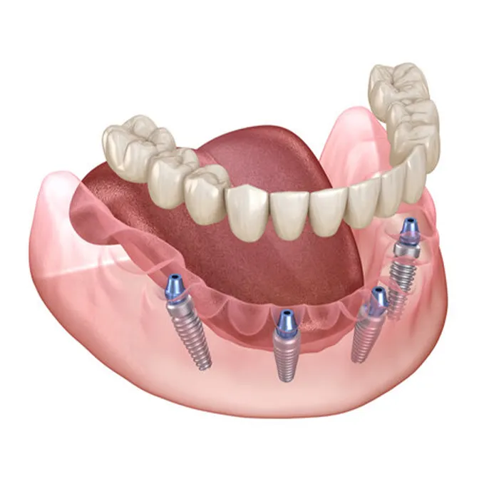 زرعات All-on-4 في إيران
