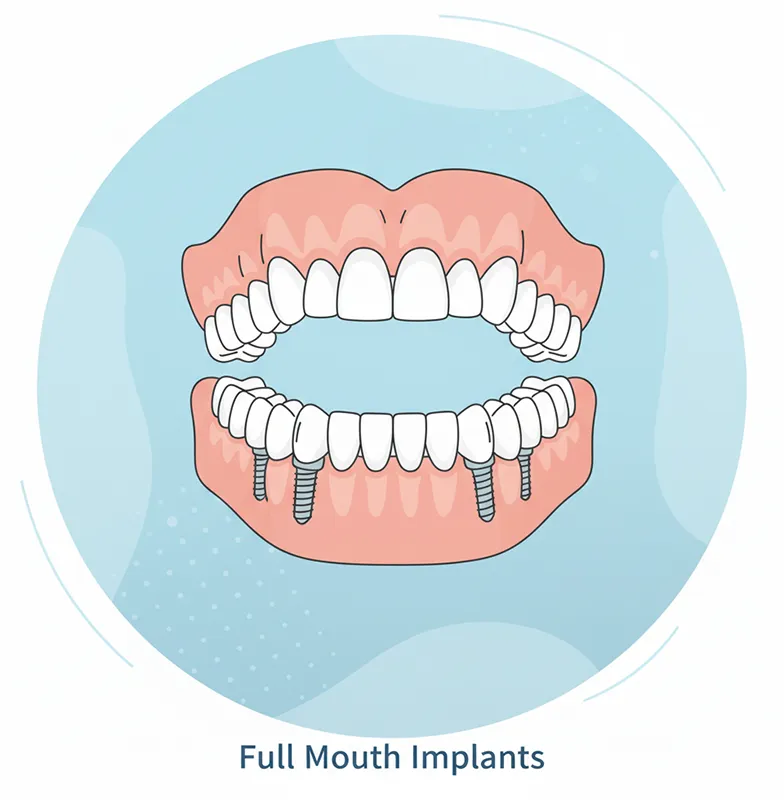 زرعات الأسنان الكاملة (All-on-4) والفم الكامل في إيران