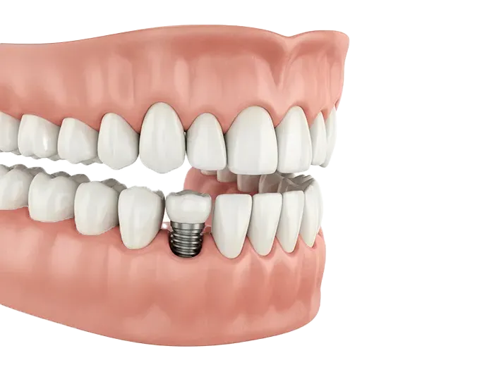 زرعات الأسنان في إيران