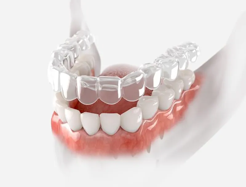 Clear Aligner in Iran
