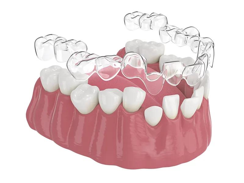 Clear Aligner in Iran