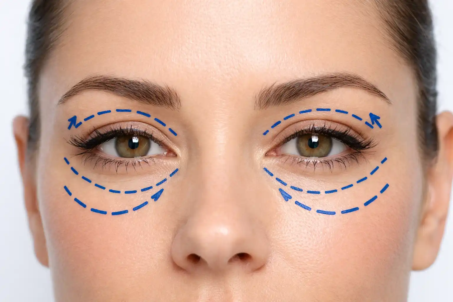 Eyelid Surgery in Iran