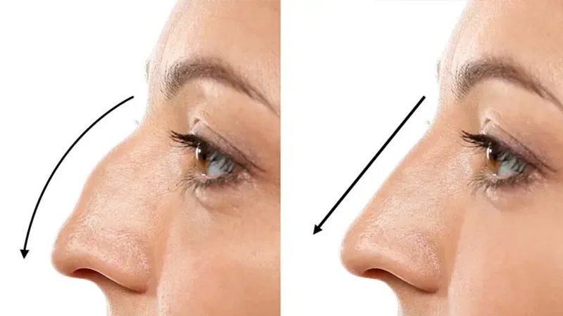 Bony vs Fleshy Nose