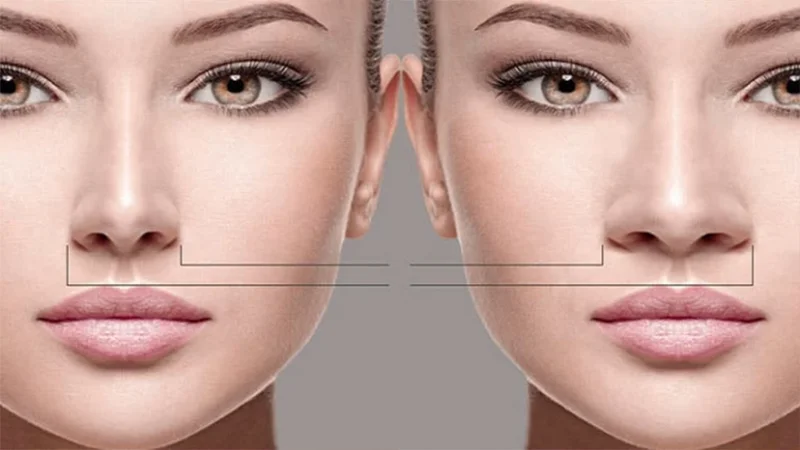 Bony vs Fleshy Nose