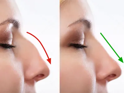 Primary Rhinoplasty iran
