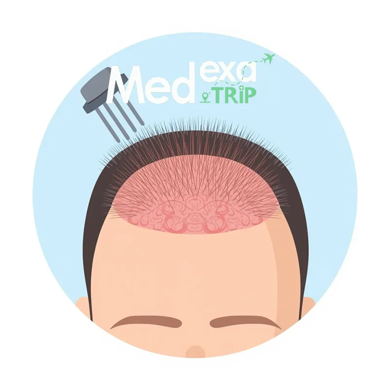 hair transplant iran ahvaz