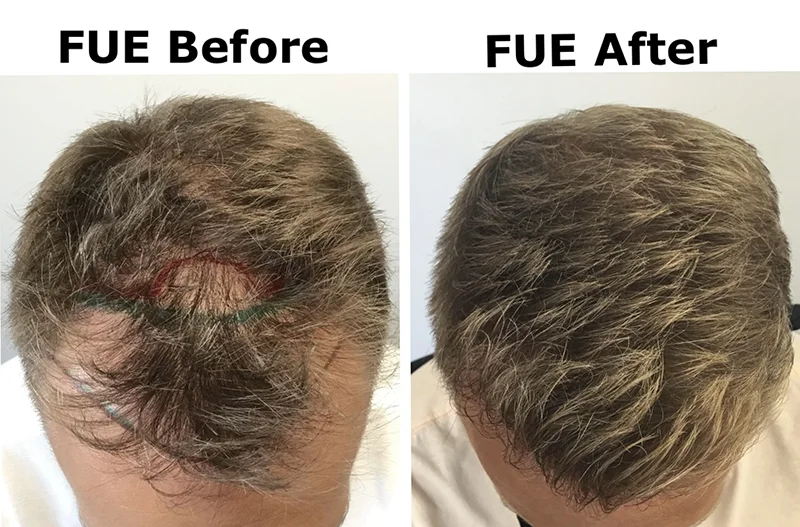 types of hair transplant