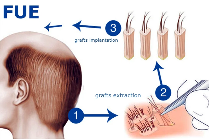 أنواع زراعة الشعر