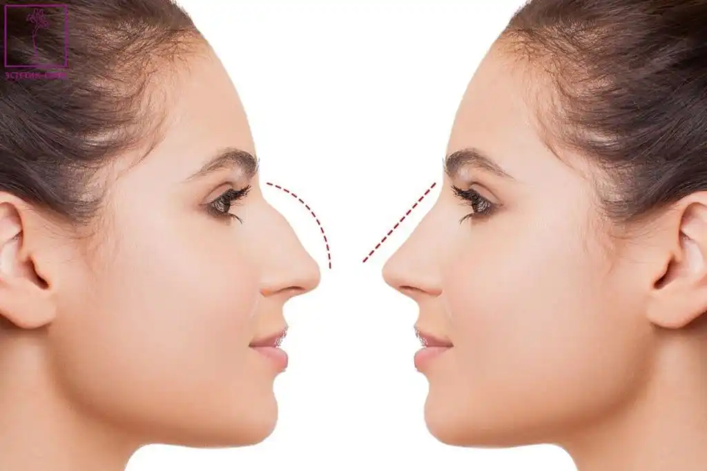 تجميل الأنف للأنف الأفطس وأنف الزر
